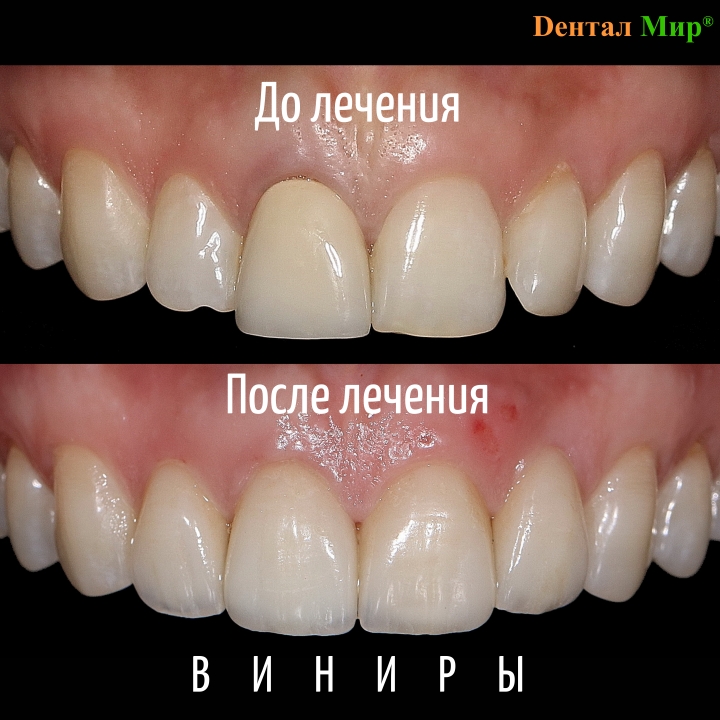 Керамические виниры на фронтальные верхние зубы. 