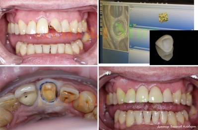 Восстановление сломанной зубной коронки с помощью безметалловой керамической коронки