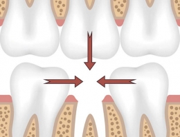 Выдвижение соседних зубов после потери одного зуба. Феномен Попова-Годона