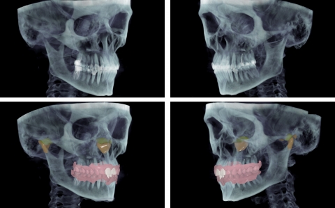Совмещение КЛКТ исследования с 3Д моделями зубов и визуализация ВНЧС