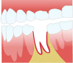 Альвеолит в лунке после удаления зуба