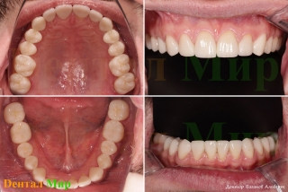 Оклюзионные и фронтальные фото верхней и нижней челюсти после лечения
