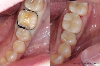 Фотография зуба до и после установки керамической накладки