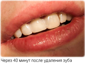 Через 40 минут после удаления