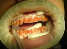 Нанесение отбеливающего геля на поверхность зубов