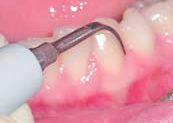 Аппаратный способ удаления твердых зубных отложений