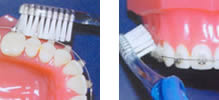Чистка брекетов и зубов с помощью ортодонтической зубной щетки