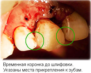 Временная коронка на имплантате