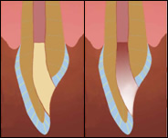 Удаление с оральной поверхности зуба пломбировочного материала