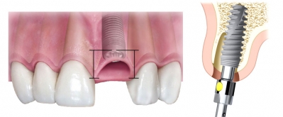 Позиционирование имплантата в лунке удаленного зуба