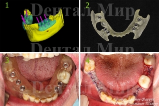 Операция имплантации зубов, выполненная с помощью хирургических 3D шаблонов