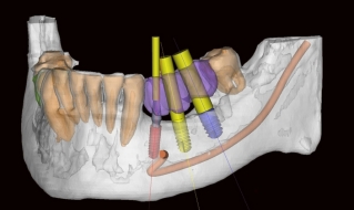 Учет расположения нижнечелюстного нерва при имплантации нижних зубов