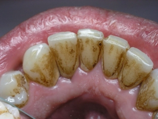 Зубной налет на нижних резцах