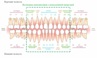 Мгновенная нагрузка при имплантации применяется на фронтальной группе зубов