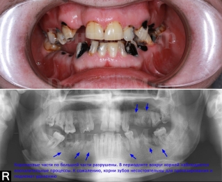 Случай, когда корни зубов не состоятельны для протезирования