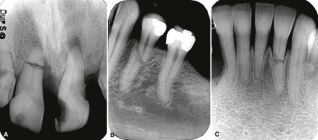 Перелом корня зуба. Примеры рентгенограмм