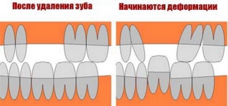 Смещение окружающих удаленный зуб внутрь. Феномен Попова-Годона