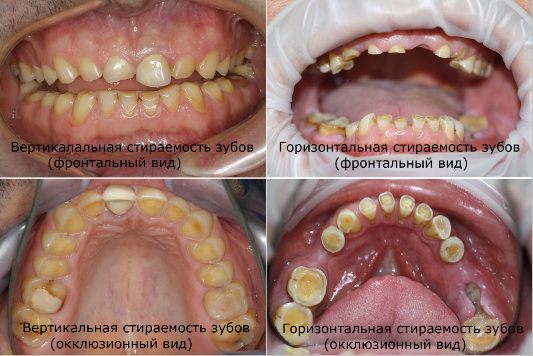Вертикальная и горизонтальная стираемость зубов