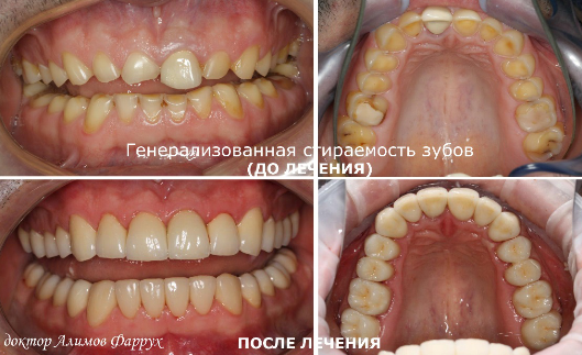 Лечение генерализованной стираемости зубов. Доктор Алимов Фаррух Казимович