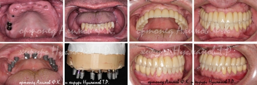 Пример работы по полной имплантации зубов