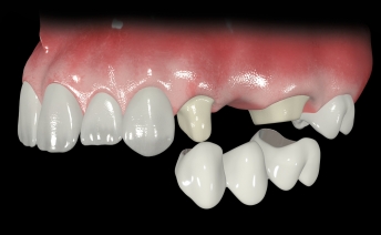 Мостовидный протез на 3 единицы. Обтачиваются два здоровых опорных зуба