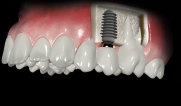 Установка единичного имплантата. Соседние зубы не повреждаются