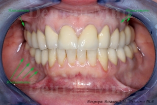 Пример работы по имплантации зубов и установке единичных коронок