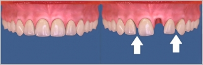 Изменение структуры кости верхней челюсти после удаления зуба
