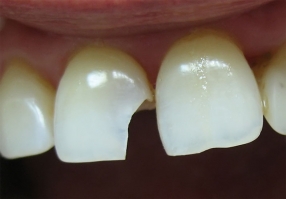 Скол на фронтальном зубе