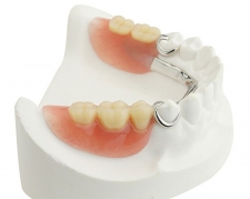 Бюгельный протез нижних жевательных зубов