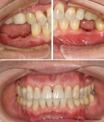 Пример работы по имплантации жевательных зубов