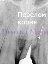 Перелом корня зуба под коронкой на рентгеновском снимке