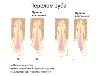 Виды переломов зуба. С вовлечением пульпы и без