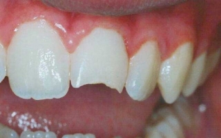Поперечный перелом коронки зуба