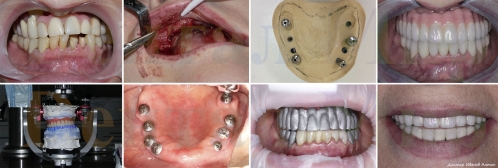 Пример работы по полному несъемному протезированию верхней челюсти на 8 имплантатах