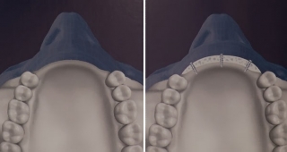 Наращивание альвеолярной кости в области передних верхних зубов по ширине