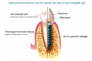 Сравнение естественного зуба и имплантата