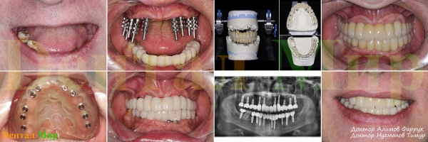 Имплантация "почти всех" зубов. Применен хирургический шаблон