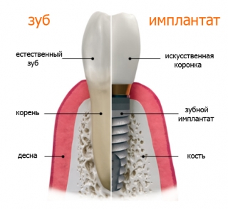 Принцип восстановления зубов с помощью имплантации