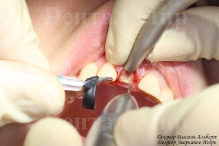 Корень аккуратно зуба удаляется