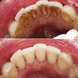 Фото до и после комплексной гигиенической чистки