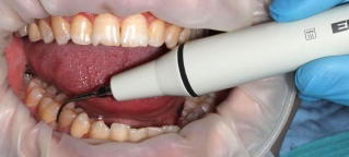 Фото процесса ультразвуковой чистки зубов