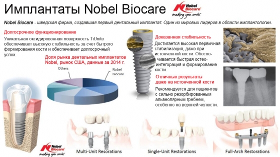 Преимущества имплантатов Nobel Biocare