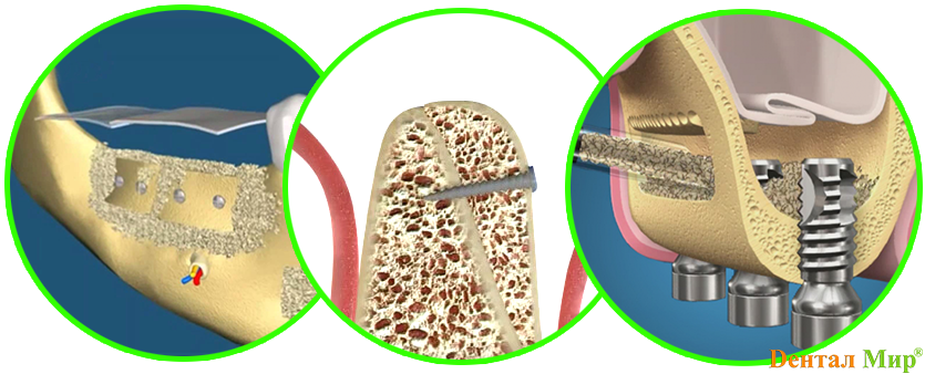 Имплантация после костной пластики. Костная пластика (остеопластика). Наращивание костной ткани для имплантов. Наращивание костной ткани в стоматологии.