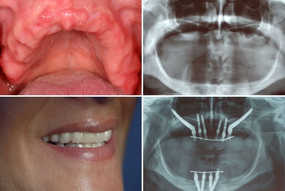 Пример применения методики All-on-4 на верхней и нижней челюсти. Также использованы имплантаты Zygoma