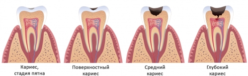 Бактерии в полости рта, попадают в микротрещины и постепенно проникают вглубь зуба, вызывая различные болевые ощущения