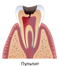 Из полости в зубе воспаление проникает в пульпу