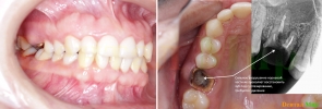 Кариозное поражение твердой ткани зуба до кости