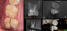 Продольная трещина зуба