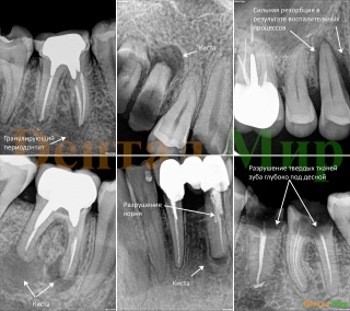 Рентгенологические исследования зубов перед их удалением